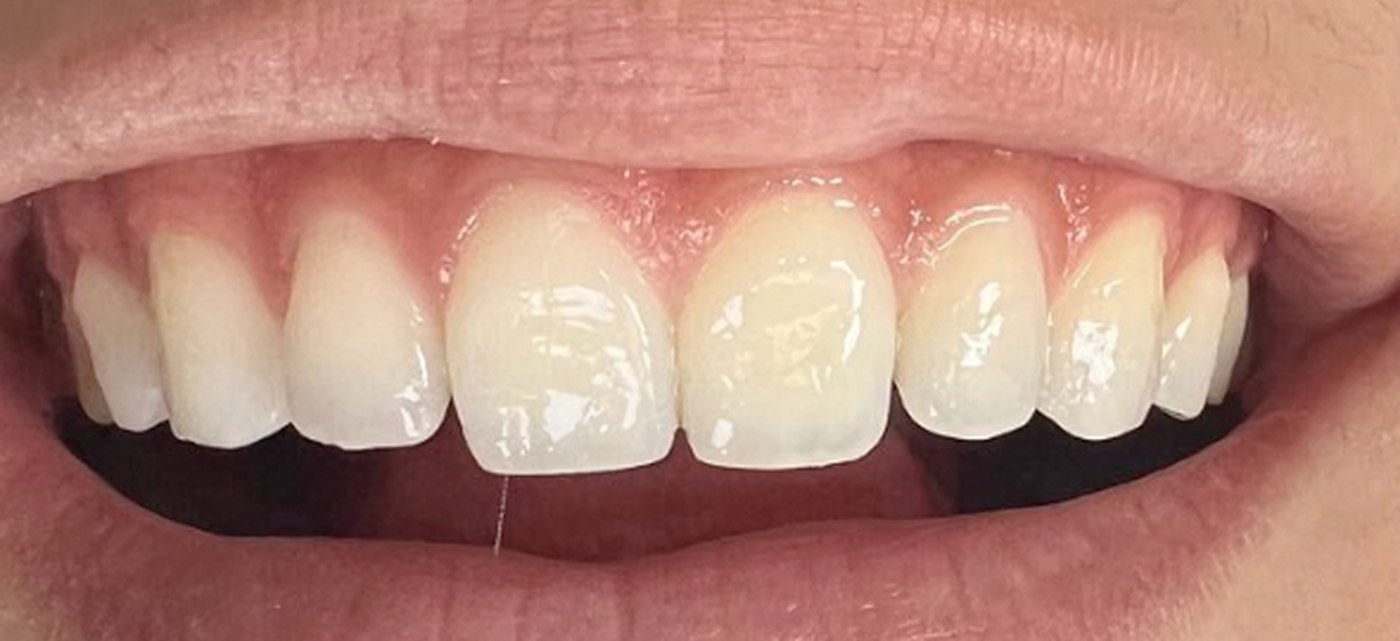 Blanqueamiento dental — antes