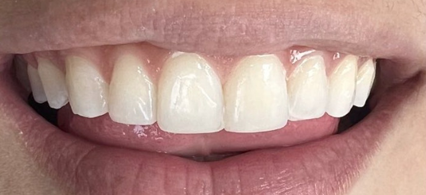 Encías y dientes tras el tratamiento