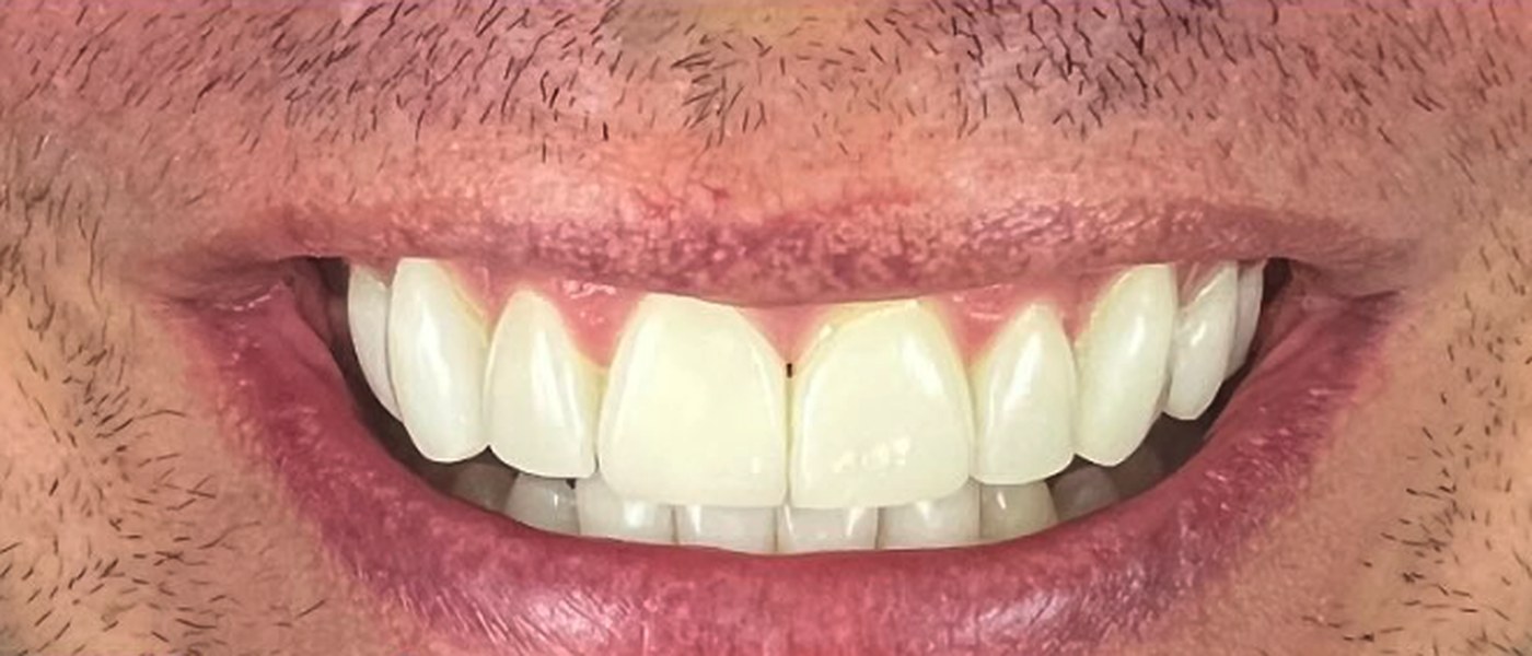 Carillas de porcelana realizadas en Qualis