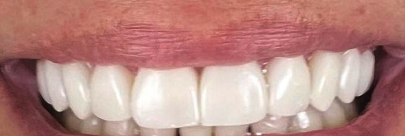 Diseño de sonrisa completo — después