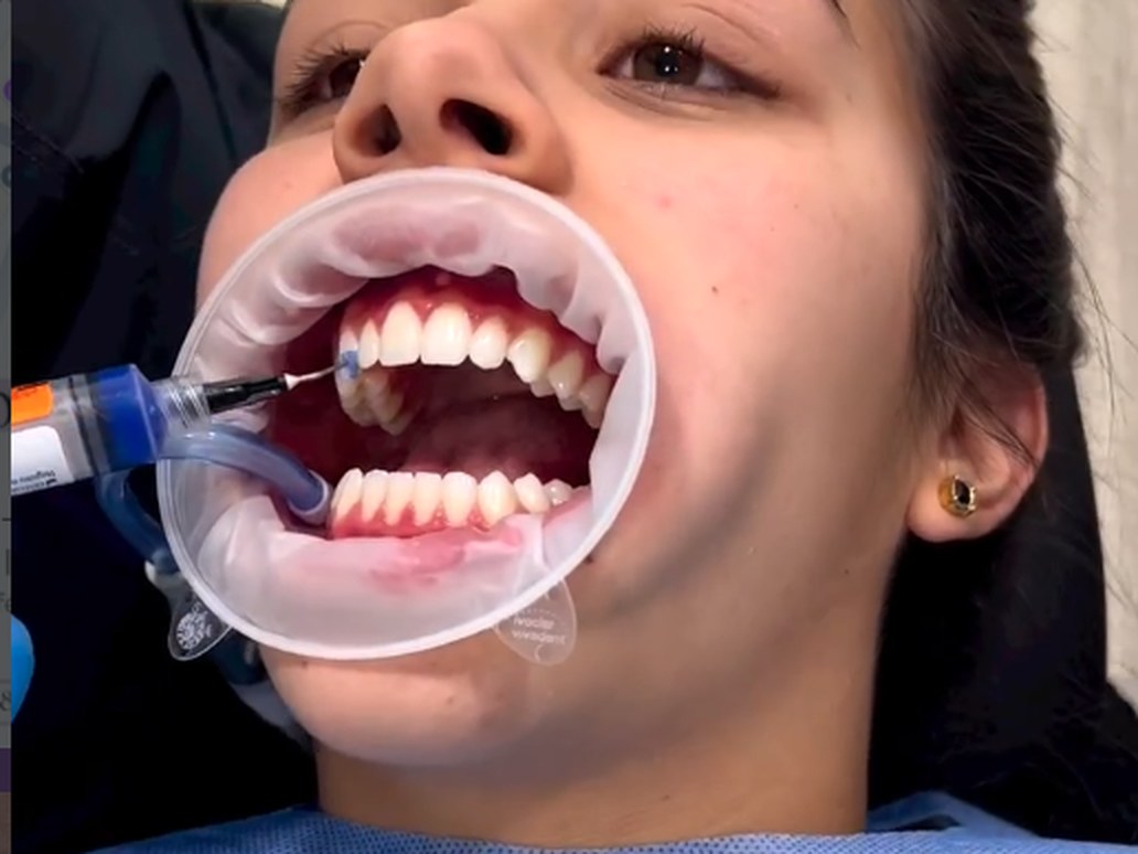 Blanqueamiento dental en curso en Qualis